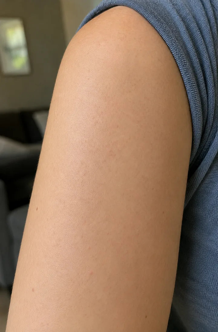 Upper arm after using the Skin Resurfacing Cream